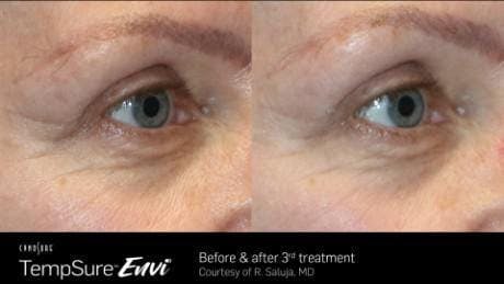 Skin Tightening Before & After Gallery - Patient 41897288 - Image 1