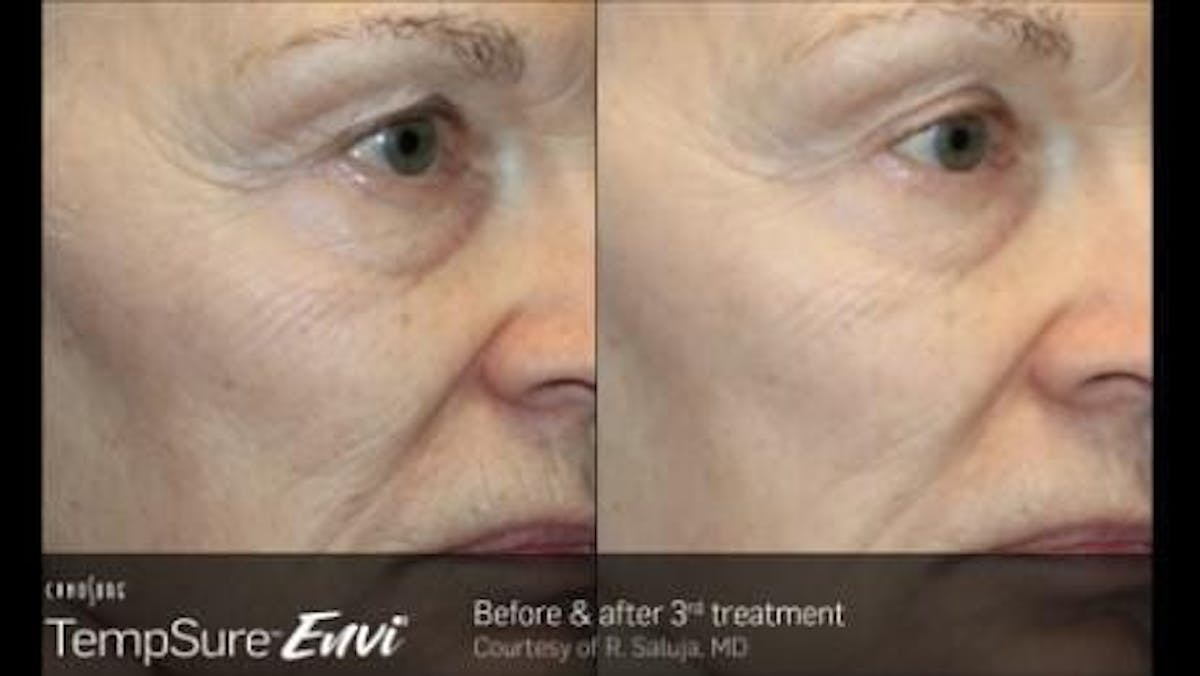 Skin Tightening Before & After Gallery - Patient 41897289 - Image 1
