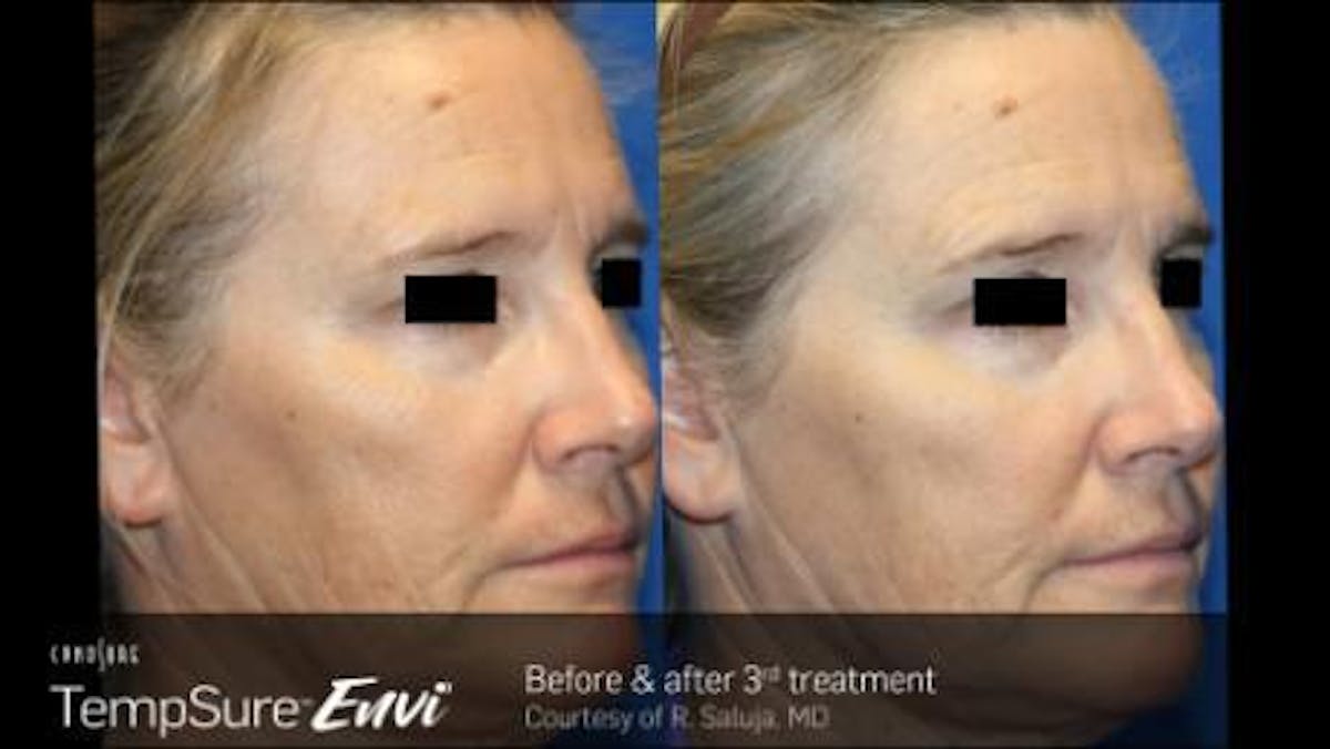 Skin Tightening Before & After Gallery - Patient 41897290 - Image 1