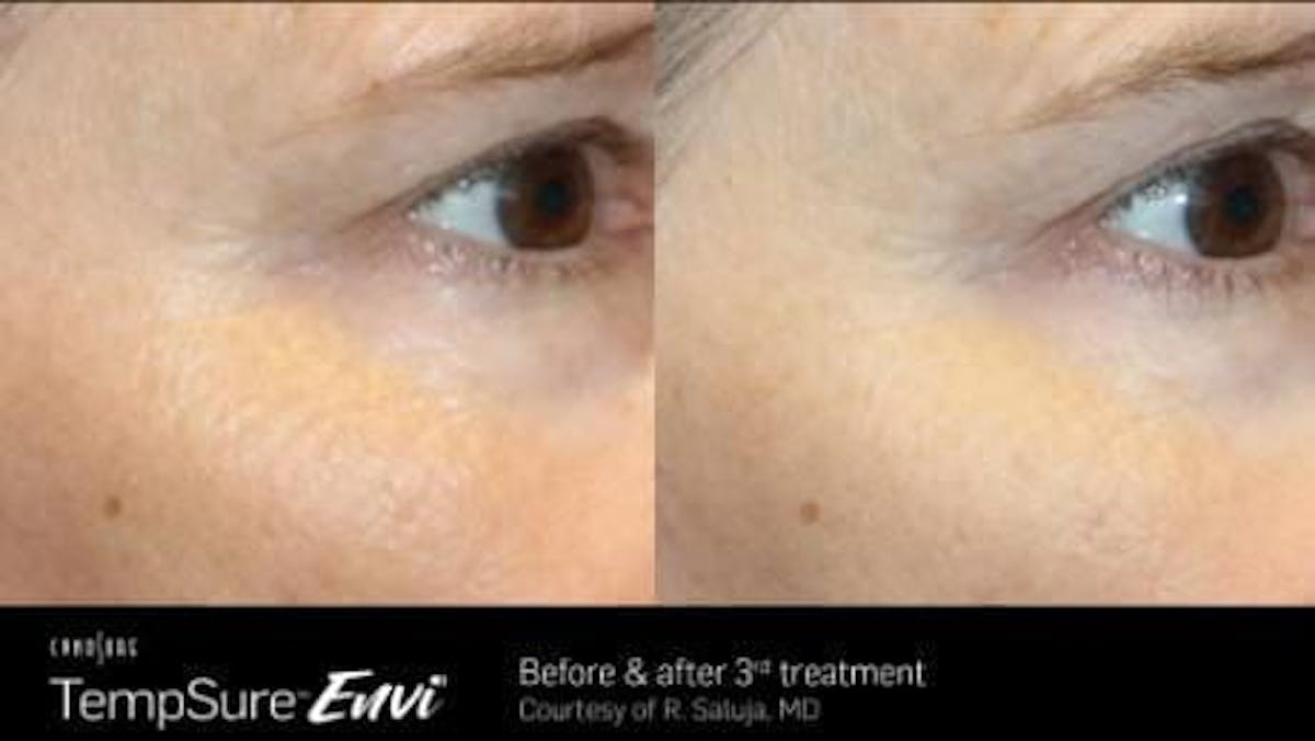 Skin Tightening Before & After Gallery - Patient 41897291 - Image 1