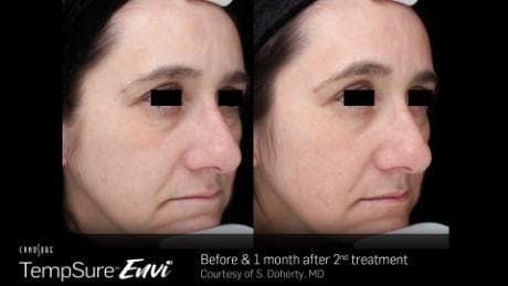 Skin Tightening Before & After Gallery - Patient 41897292 - Image 1