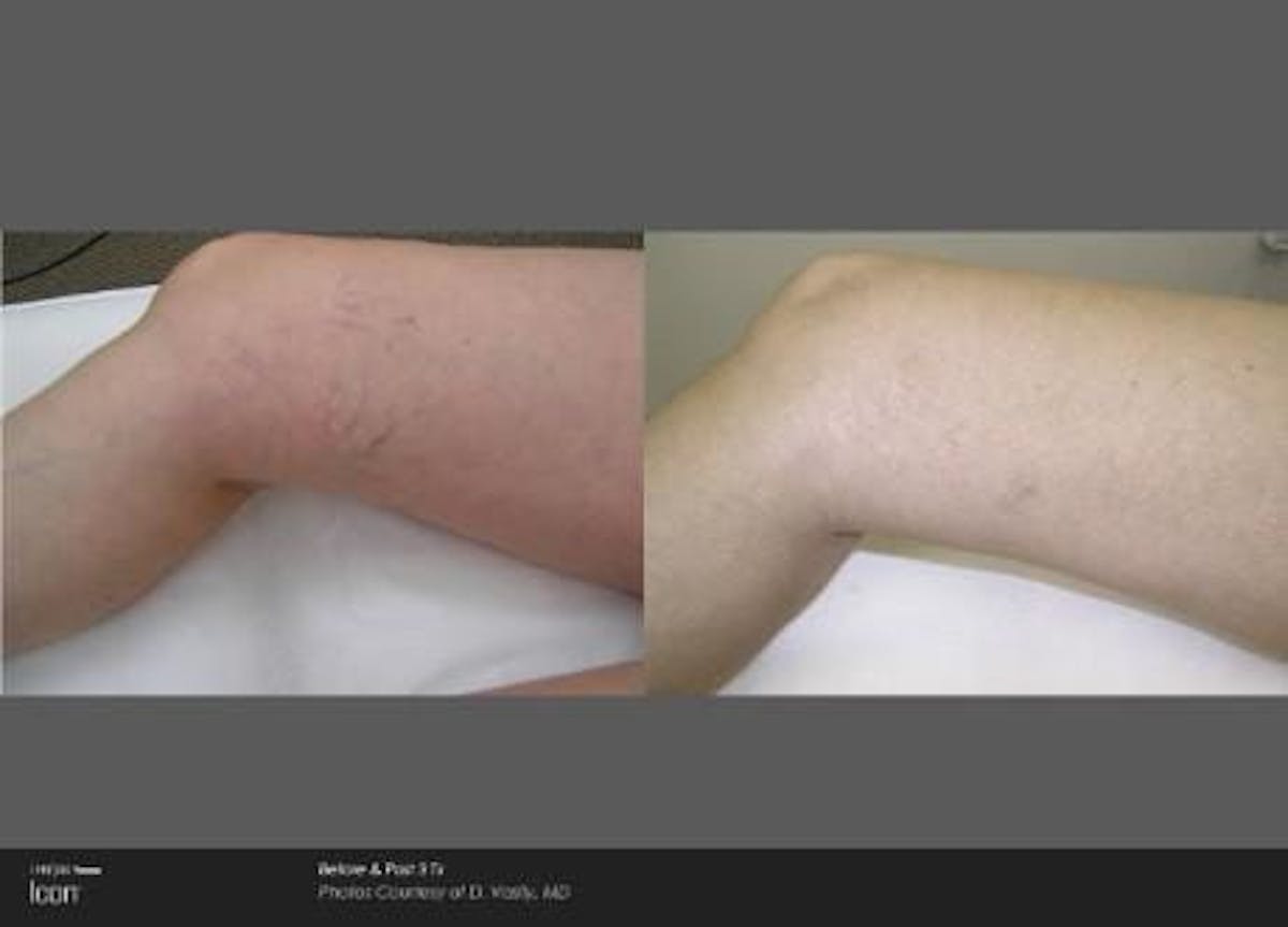Skin Rejuvenation Before & After Gallery - Patient 41897301 - Image 1