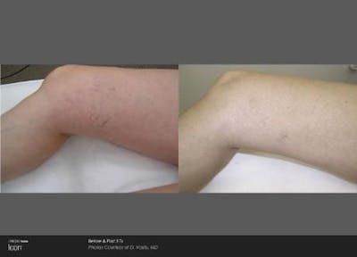 Skin Rejuvenation Before & After Gallery - Patient 41897301 - Image 1