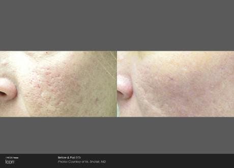 Skin Rejuvenation Before & After Gallery - Patient 41897303 - Image 1