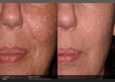 Skin Rejuvenation Before & After Gallery - Patient 41897304 - Image 1