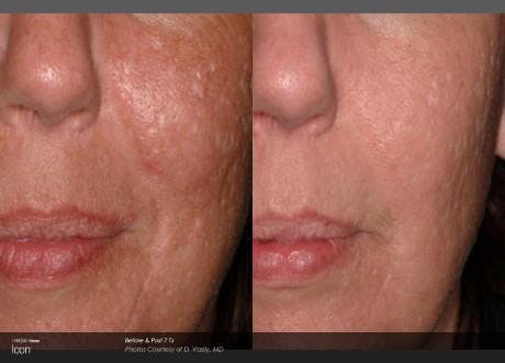 Skin Rejuvenation Before & After Gallery - Patient 41897304 - Image 1