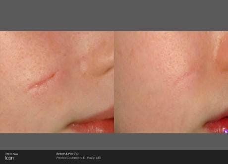 Skin Rejuvenation Before & After Gallery - Patient 41897305 - Image 1