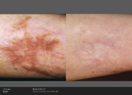 Skin Rejuvenation Before & After Gallery - Patient 41897306 - Image 1