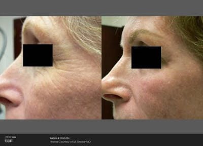 Skin Rejuvenation Before & After Gallery - Patient 41897307 - Image 1