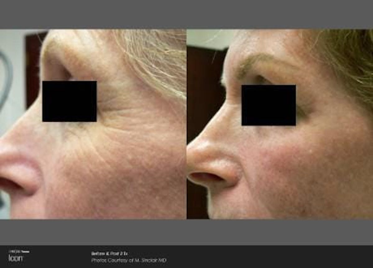 Skin Rejuvenation Before & After Gallery - Patient 41897307 - Image 1
