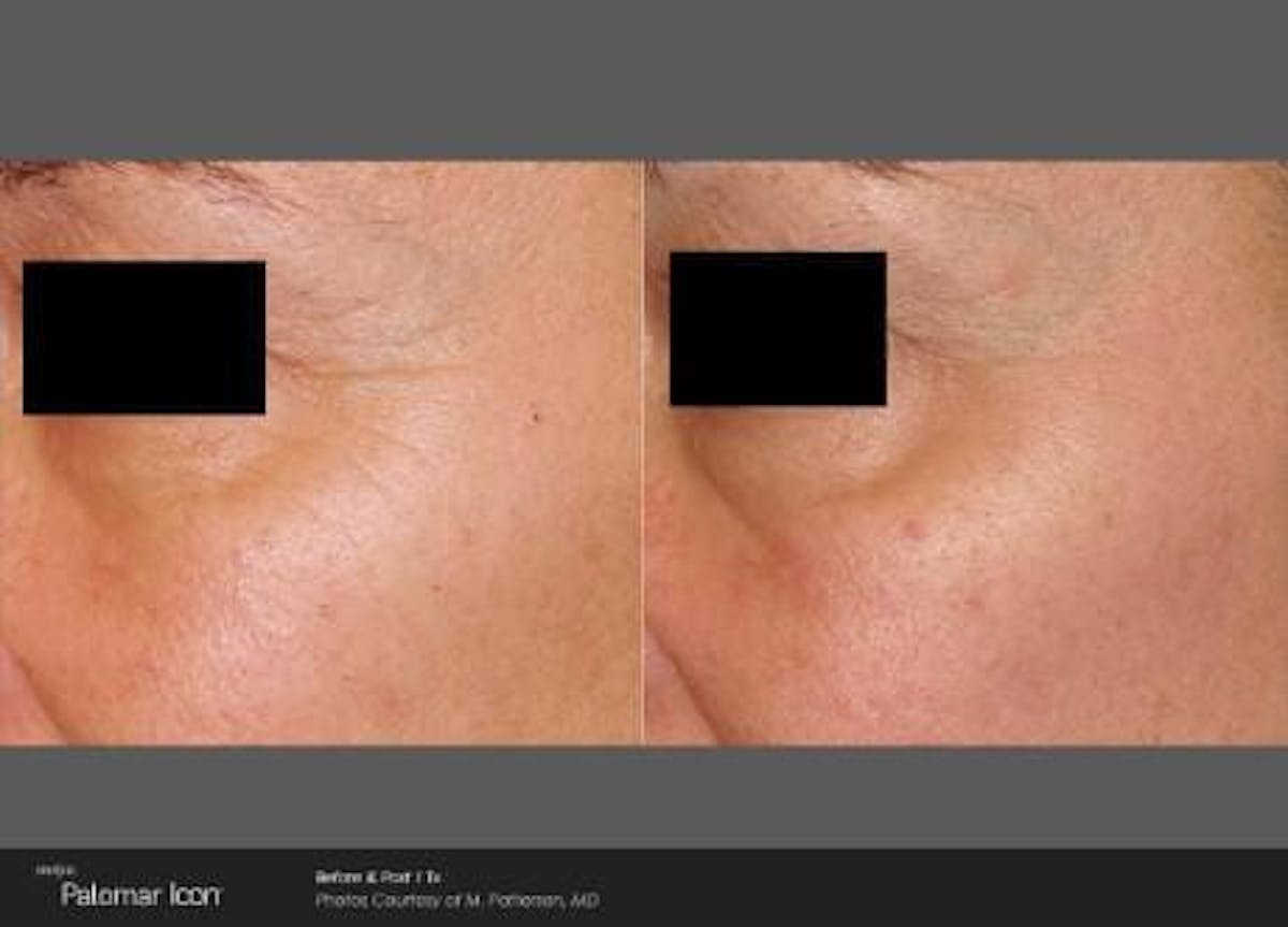 Skin Rejuvenation Before & After Gallery - Patient 41897308 - Image 1