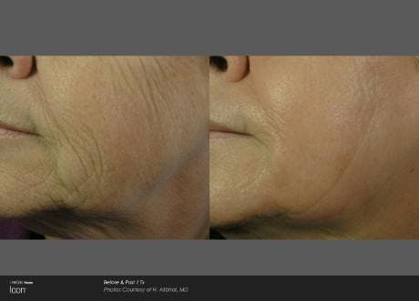 Skin Rejuvenation Before & After Gallery - Patient 41897309 - Image 1
