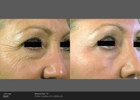 Skin Rejuvenation Before & After Gallery - Patient 41897310 - Image 1