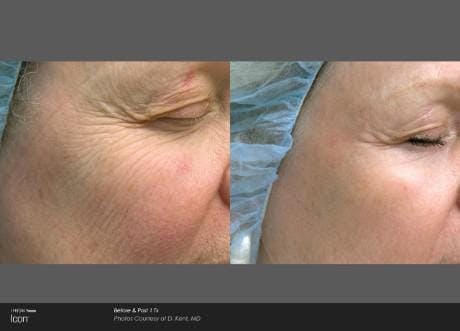 Skin Rejuvenation Before & After Gallery - Patient 41897311 - Image 1