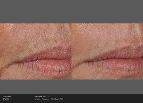 lip procedure