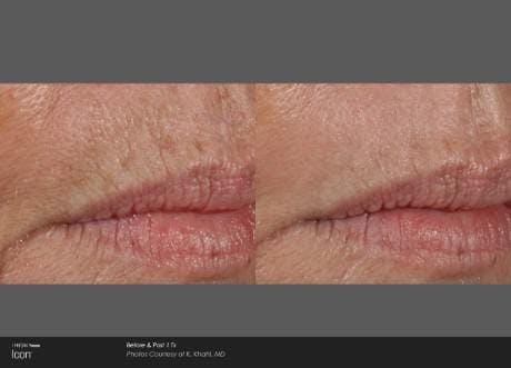 Skin Rejuvenation Before & After Gallery - Patient 41897312 - Image 1