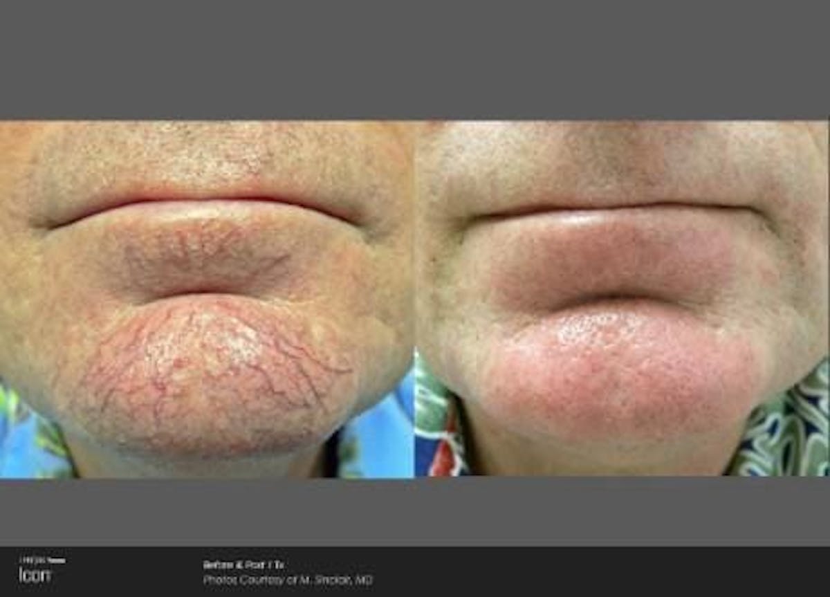 Skin Rejuvenation Before & After Gallery - Patient 41897313 - Image 1