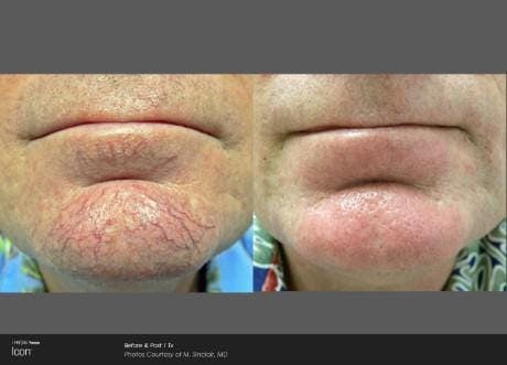 Skin Rejuvenation Before & After Gallery - Patient 41897313 - Image 1