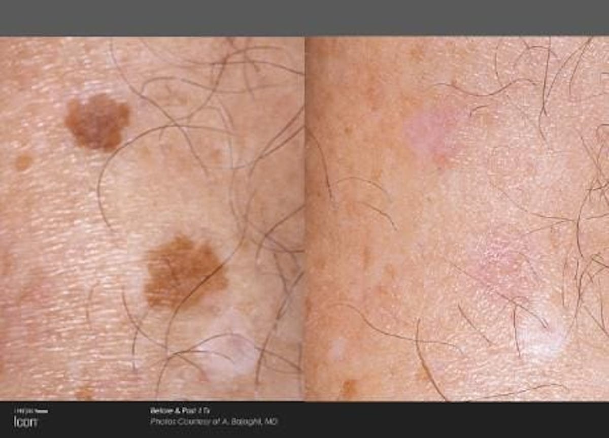 Skin Rejuvenation Before & After Gallery - Patient 41897314 - Image 1