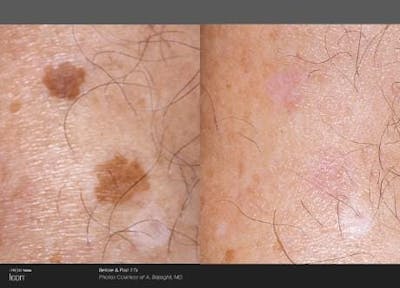 Skin Rejuvenation Before & After Gallery - Patient 41897314 - Image 1
