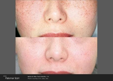 Skin Rejuvenation Before & After Gallery - Patient 41897315 - Image 1