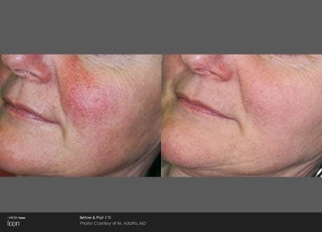 Skin Rejuvenation Before & After Gallery - Patient 41897316 - Image 1