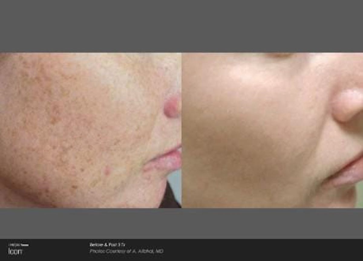 Skin Rejuvenation Before & After Gallery - Patient 41897317 - Image 1