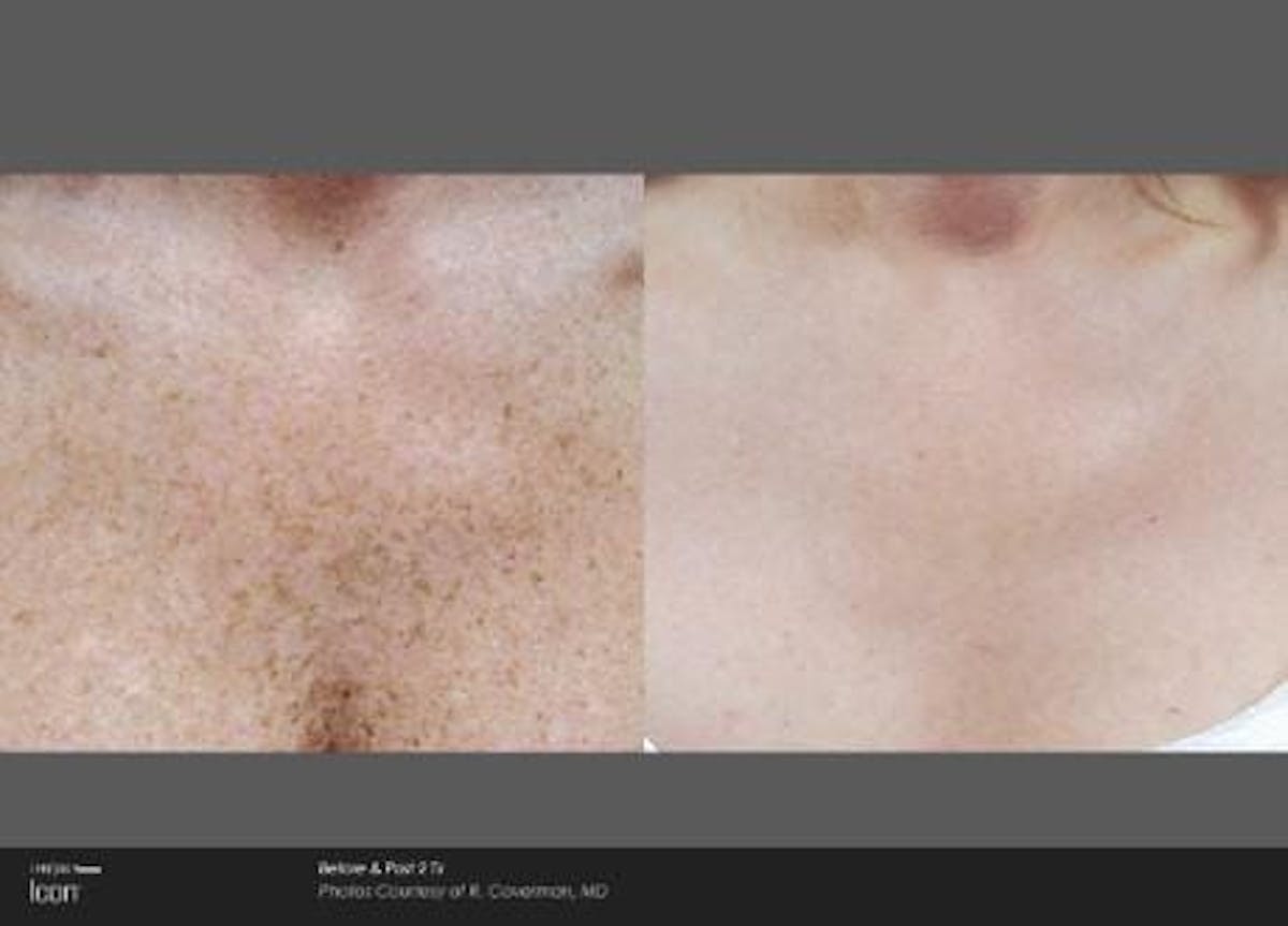 Skin Rejuvenation Before & After Gallery - Patient 41897318 - Image 1