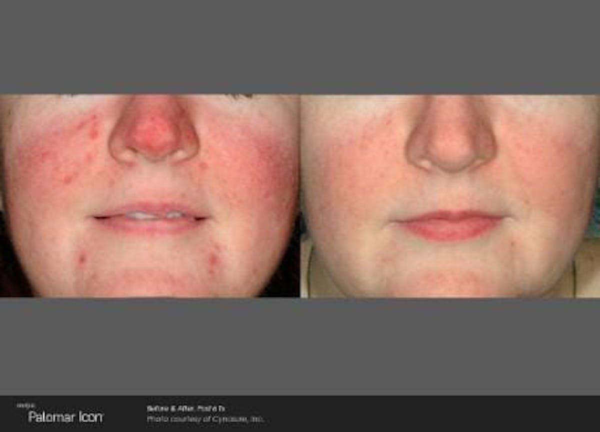 Skin Rejuvenation Before & After Gallery - Patient 41897319 - Image 1