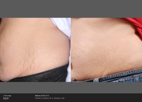 Skin Rejuvenation Before & After Gallery - Patient 41897320 - Image 1