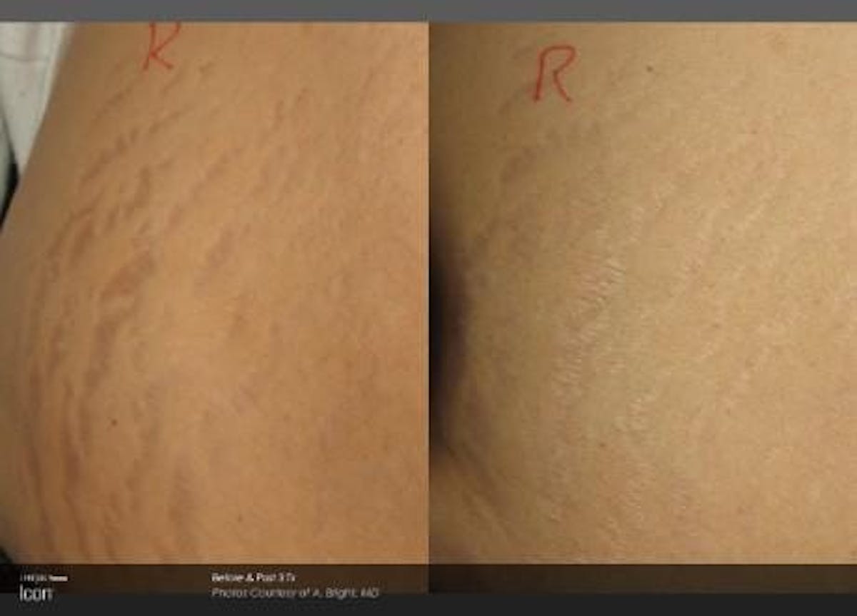 Skin Rejuvenation Before & After Gallery - Patient 41897321 - Image 1
