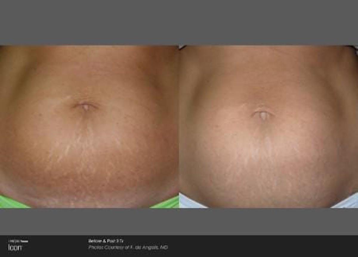 Skin Rejuvenation Before & After Gallery - Patient 41897322 - Image 1