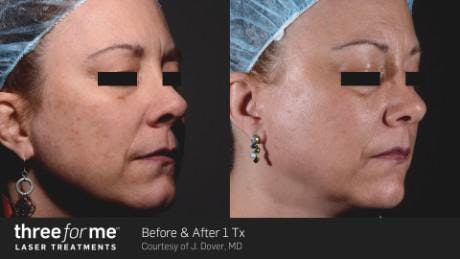 Skin Rejuvenation Before & After Gallery - Patient 41897324 - Image 1