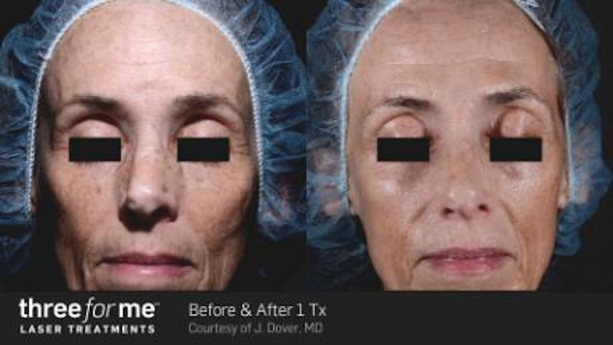 Skin Rejuvenation Before & After Gallery - Patient 41897325 - Image 1