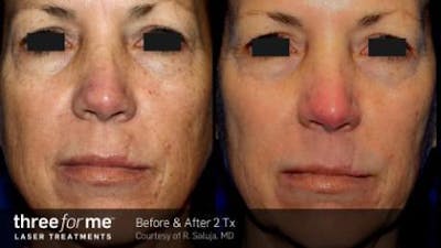 Skin Rejuvenation Before & After Gallery - Patient 41897326 - Image 1