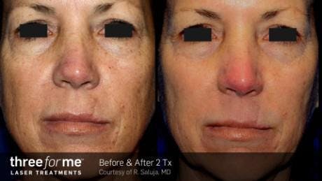 Skin Rejuvenation Before & After Gallery - Patient 41897326 - Image 1