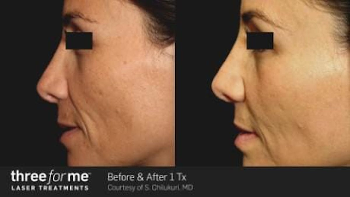 Skin Rejuvenation Before & After Gallery - Patient 41897327 - Image 1