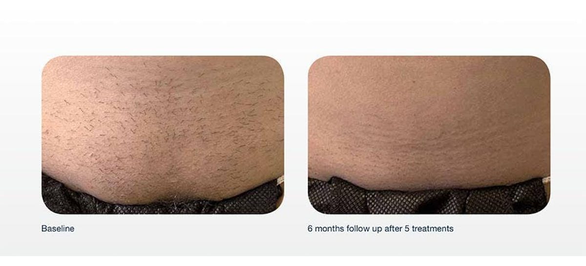 Hair Removal Before & After Gallery - Patient 41897330 - Image 1