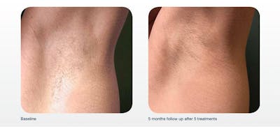 Hair Removal Before & After Gallery - Patient 41897331 - Image 1