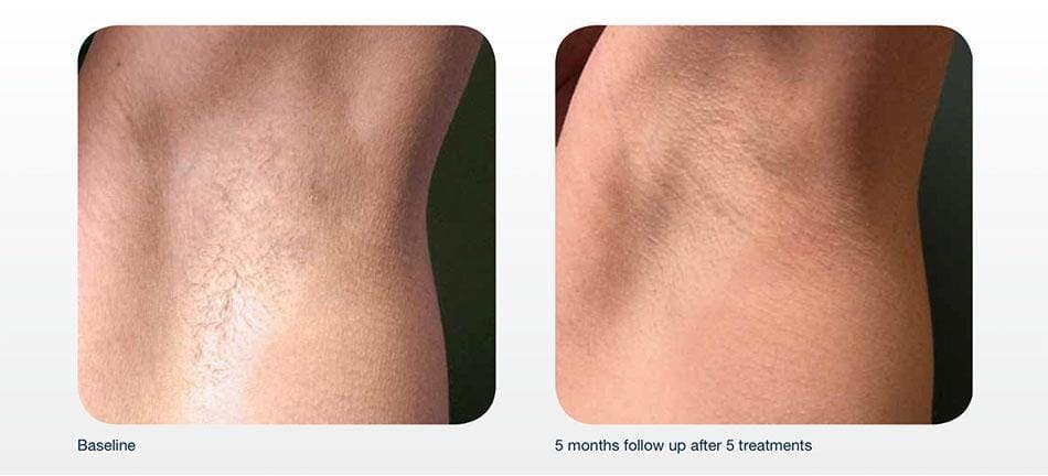 Hair Removal Before & After Gallery - Patient 41897331 - Image 1