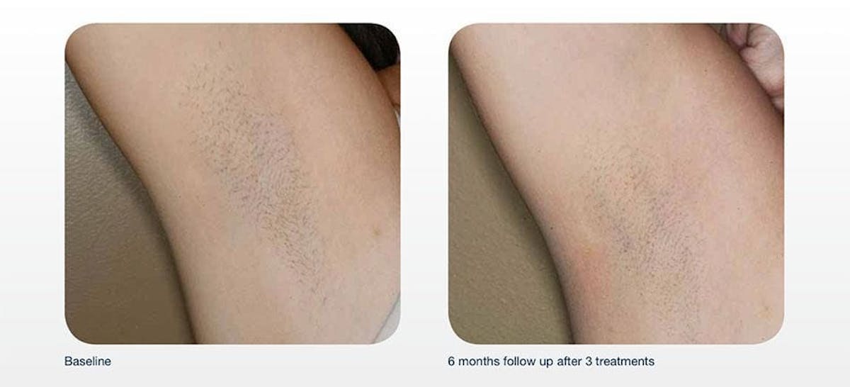 Hair Removal Before & After Gallery - Patient 41897332 - Image 1