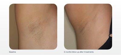 Hair Removal Before & After Gallery - Patient 41897333 - Image 1