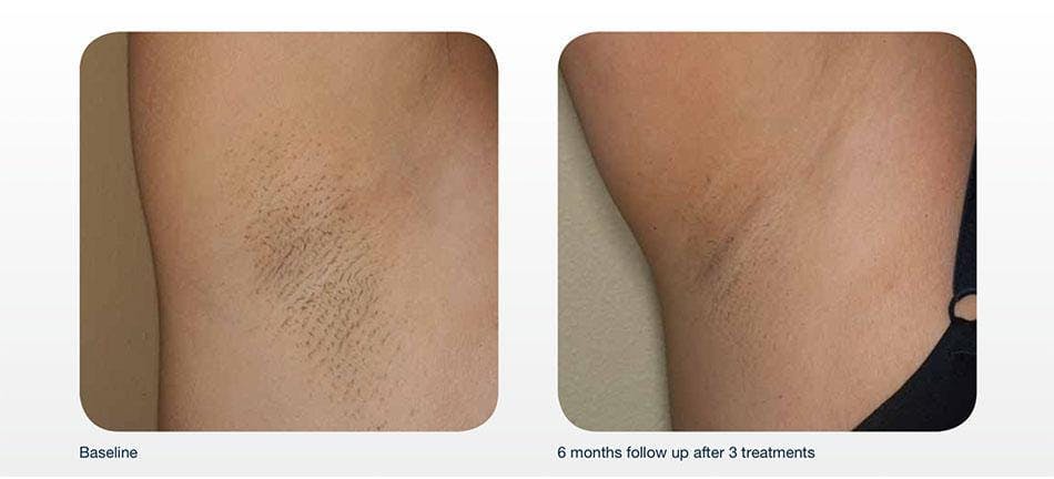 Hair Removal Before & After Gallery - Patient 41897333 - Image 1
