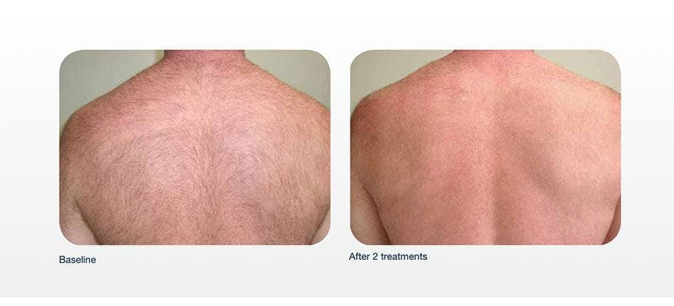 Hair Removal Before & After Gallery - Patient 41897334 - Image 1