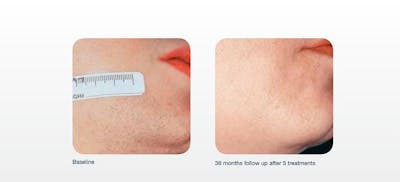 Hair Removal Before & After Gallery - Patient 41897335 - Image 1