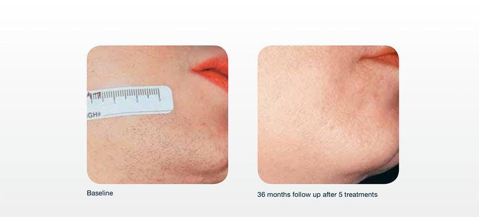 Hair Removal Before & After Gallery - Patient 41897335 - Image 1