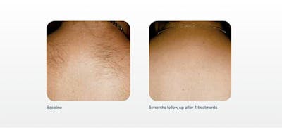 Hair Removal Before & After Gallery - Patient 41897336 - Image 1