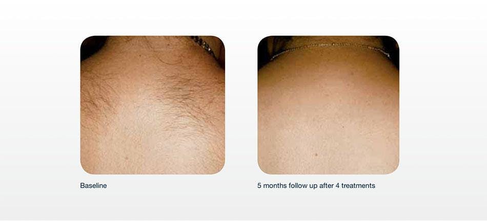 Hair Removal Before & After Gallery - Patient 41897336 - Image 1