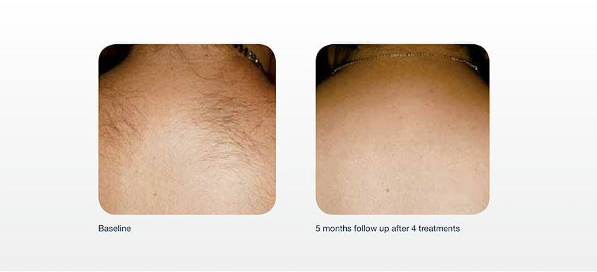 Hair Removal Before & After Gallery - Patient 41897336 - Image 1
