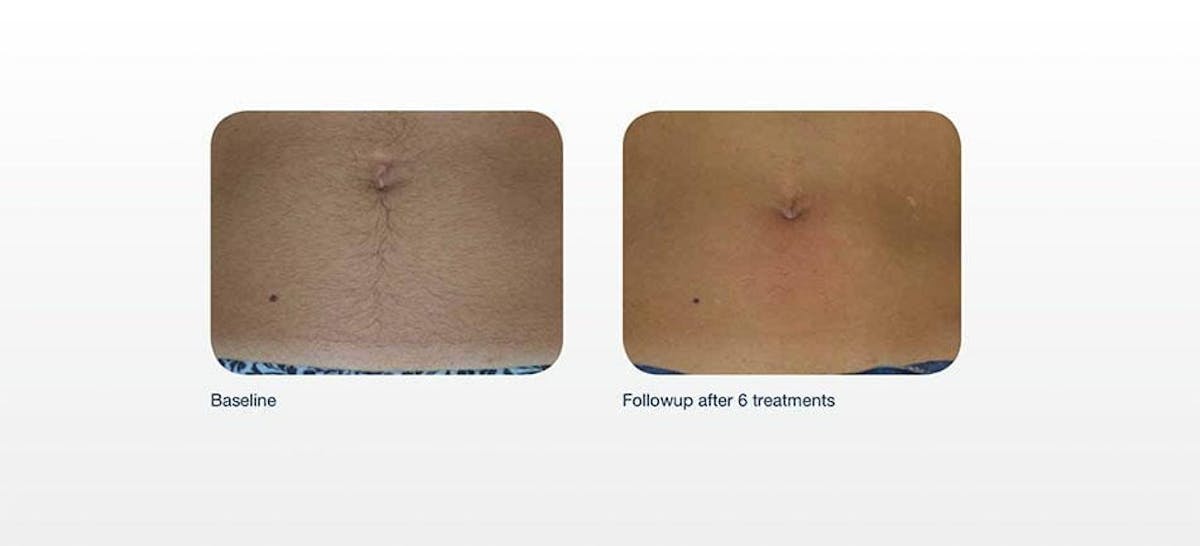 Hair Removal Before & After Gallery - Patient 41897340 - Image 1